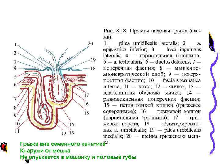 Грыжа вне семенного канатика Кнаружи от мешка Не опускается в мошонку и половые губы