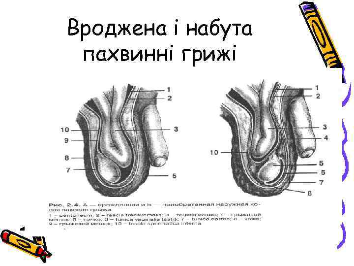 Вроджена і набута пахвинні грижі 