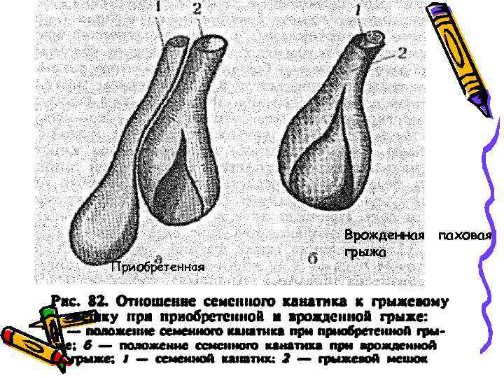 Приобретенная Врожденная паховая грыжа 