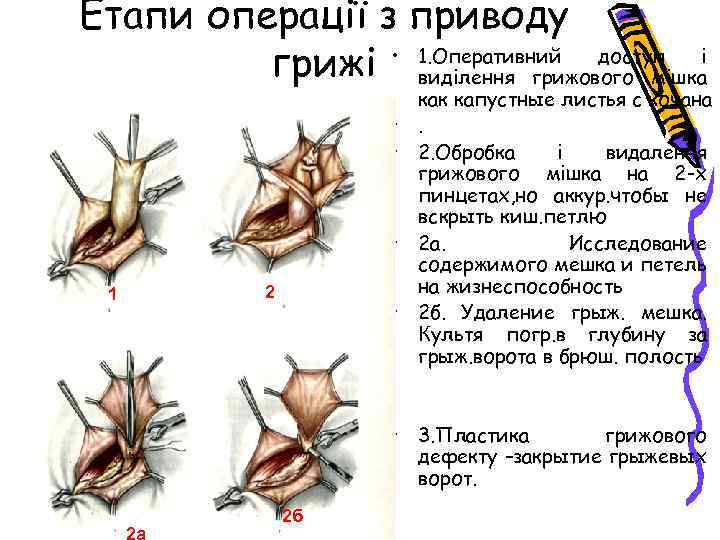 Етапи операції з приводу • 1. Оперативний доступ і грижі виділення грижового мішка •