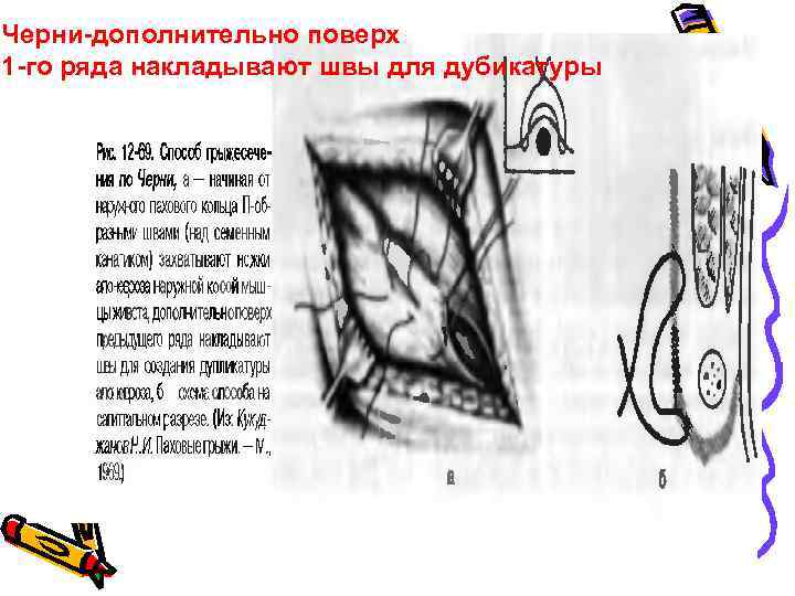 Черни-дополнительно поверх 1 -го ряда накладывают швы для дубикатуры 