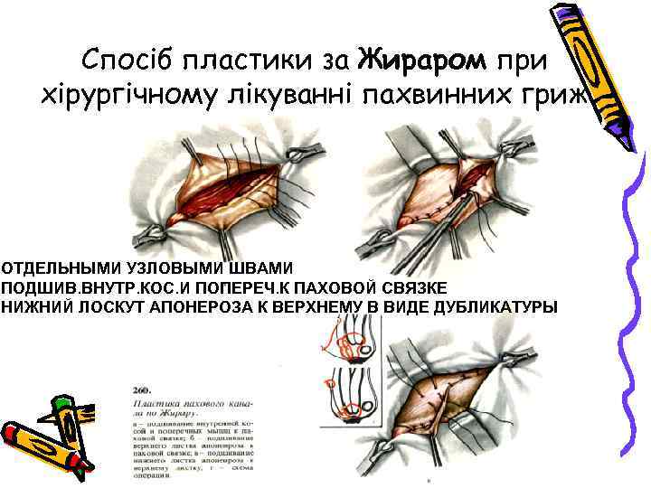 Спосіб пластики за Жираром при хірургічному лікуванні пахвинних гриж ОТДЕЛЬНЫМИ УЗЛОВЫМИ ШВАМИ ПОДШИВ. ВНУТР.