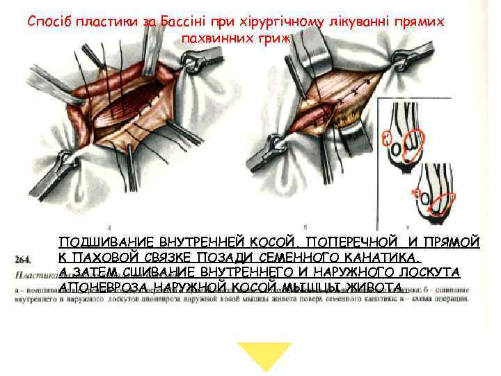 Пластика пахового канала по бассини