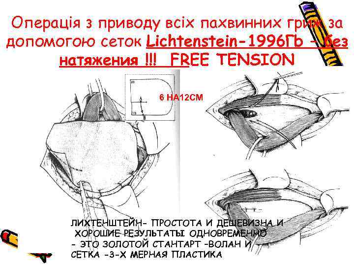 Операція з приводу всіх пахвинних гриж за допомогою сеток Lichtenstein-1996 Гb – без натяжения