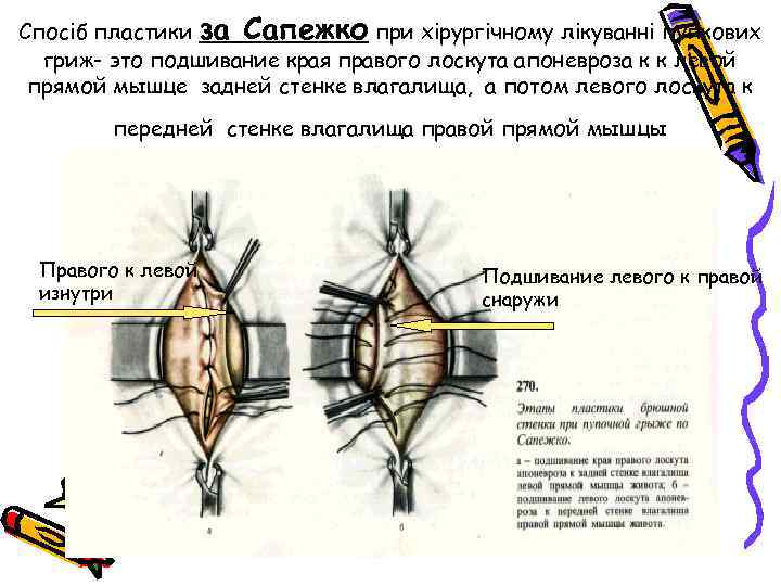 Пластика по сапежко