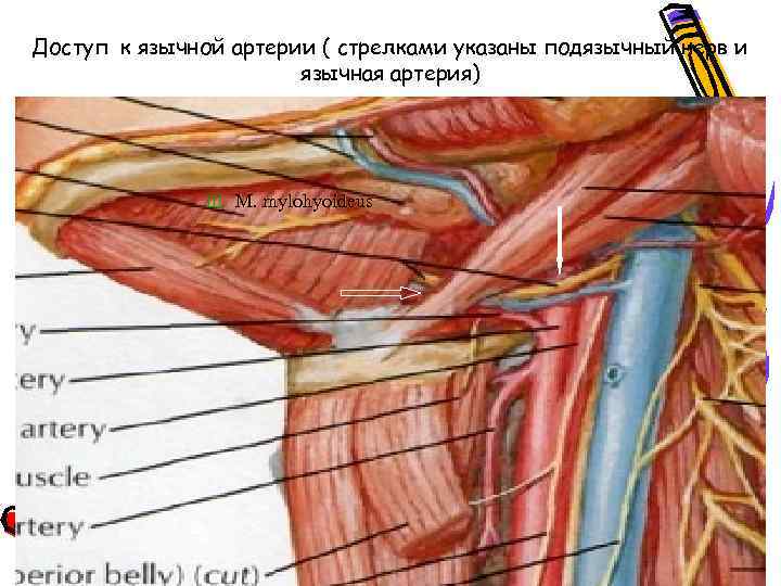 Доступ к язычной артерии ( стрелками указаны подязычный нерв и язычная артерия) Ш M.