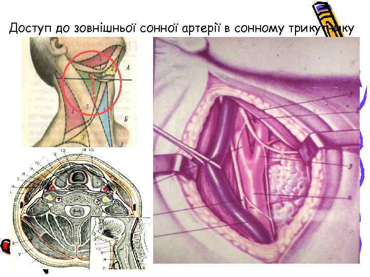 Доступ до зовнішньої сонної артерії в сонному трикутнику 