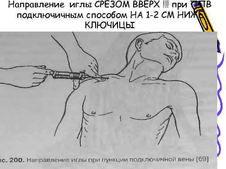 Направление иглы СРЕЗОМ ВВЕРХ !!! при ППВ подключичным способом НА 1 -2 СМ НИЖЕ