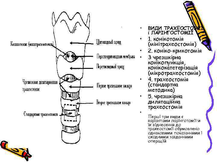  • • ВИДИ ТРАХЕОСТОМІЇ і ЛАРІНГОСТОМІЇ 1. конікотомія (мінітрахеостомія) 2. коніко-крикотомія 3 чрезшкірна