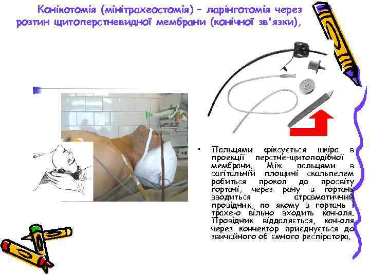 Конікотомія (мінітрахеостомія) – ларінготомія через розтин щитоперстневидної мембрани (конічної зв'язки), • Пальцями фіксується шкіра