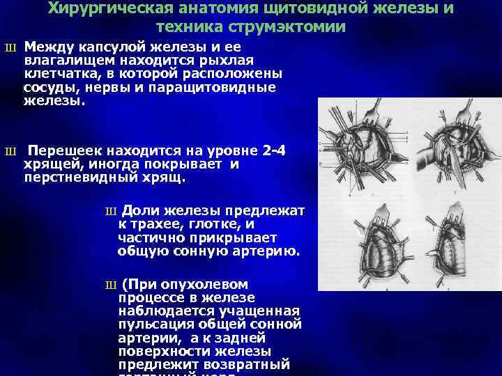 Хирургическая анатомия щитовидной железы и техника струмэктомии Ш Между капсулой железы и ее влагалищем
