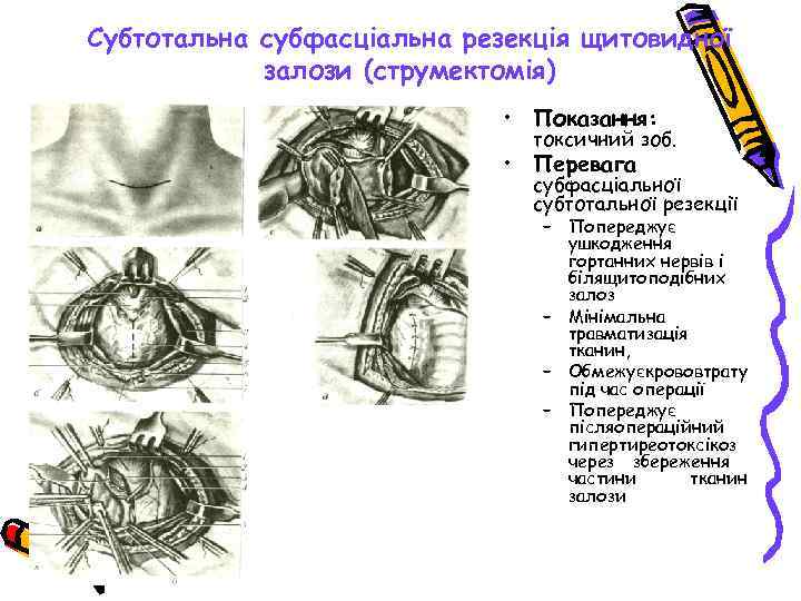 Субтотальна субфасціальна резекція щитовидної залози (струмектомія) • Показання: токсичний зоб. • Перевага субфасціальної субтотальної