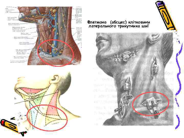 Флегмона (абсцес) клітковини латерального трикутника шиї 