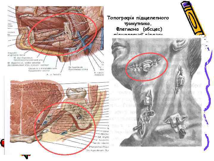 Топографія підщелепного трикутника. Флегмона (абсцес) підщелепної ділянки 