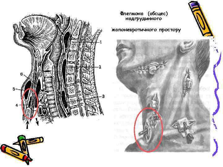 Флегмона (абсцес) надгрудинного міжапоневротичного простору 