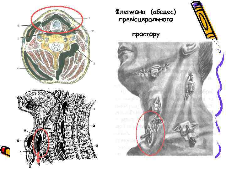 Флегмона (абсцес) превісцерального простору 
