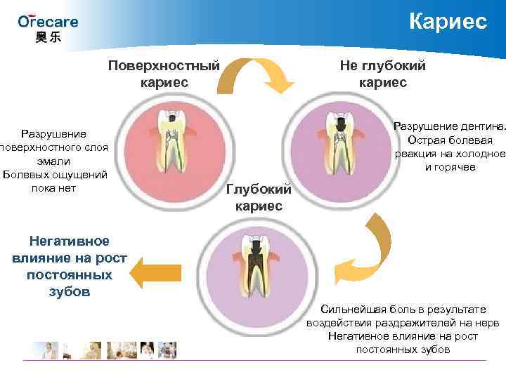 Кариес Поверхностный кариес Разрушение поверхностного слоя эмали Болевых ощущений пока нет Не глубокий кариес