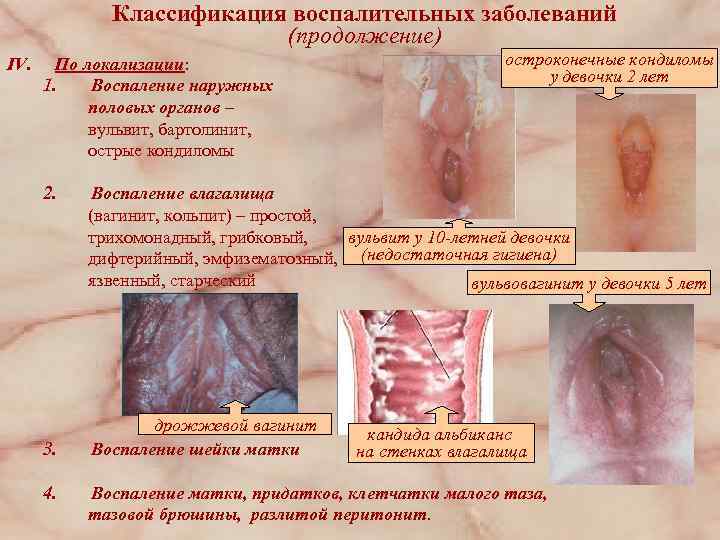 Классификация воспалительных заболеваний (продолжение) IV. По локализации: 1. Воспаление наружных половых органов – вульвит,