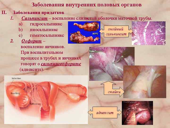 Заболевания внутренних половых органов II. Заболевания придатков 1. Сальпингит – воспаление слизистой оболочки маточной