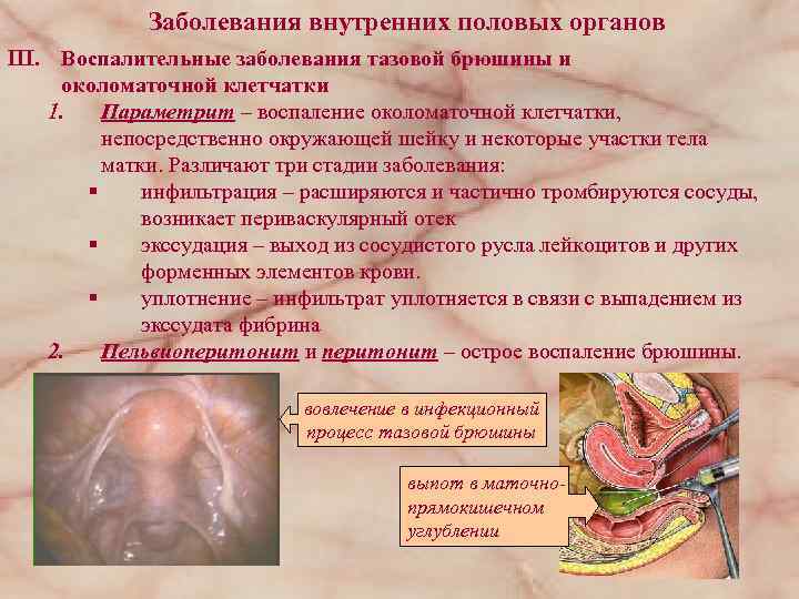 Заболевания внутренних половых органов III. Воспалительные заболевания тазовой брюшины и околоматочной клетчатки 1. Параметрит