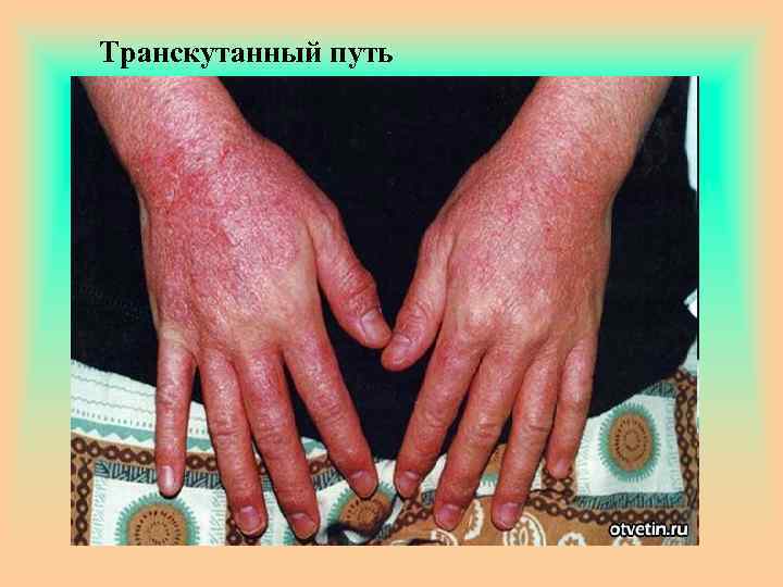 Транскутанный путь 