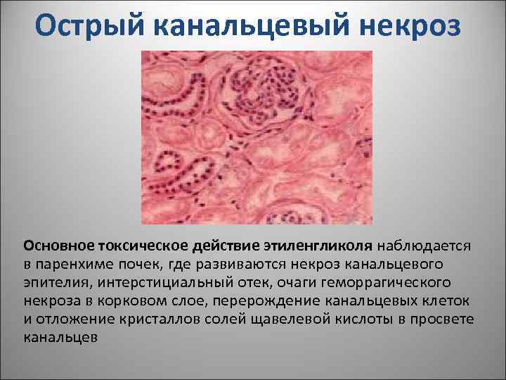  Острый канальцевый некроз Основное токсическое действие этиленгликоля наблюдается в паренхиме почек, где развиваются