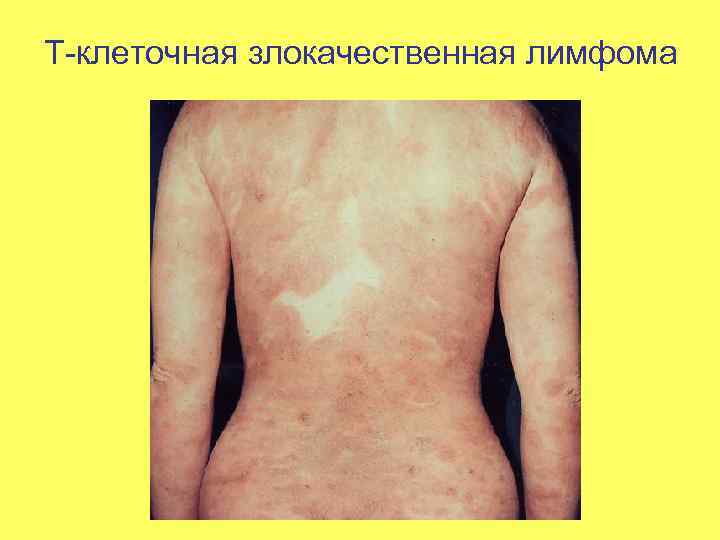 Т-клеточная злокачественная лимфома 
