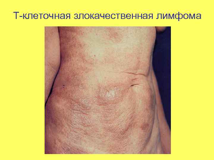 Т-клеточная злокачественная лимфома 