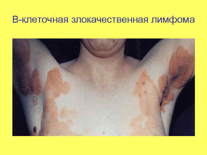 В-клеточная злокачественная лимфома 
