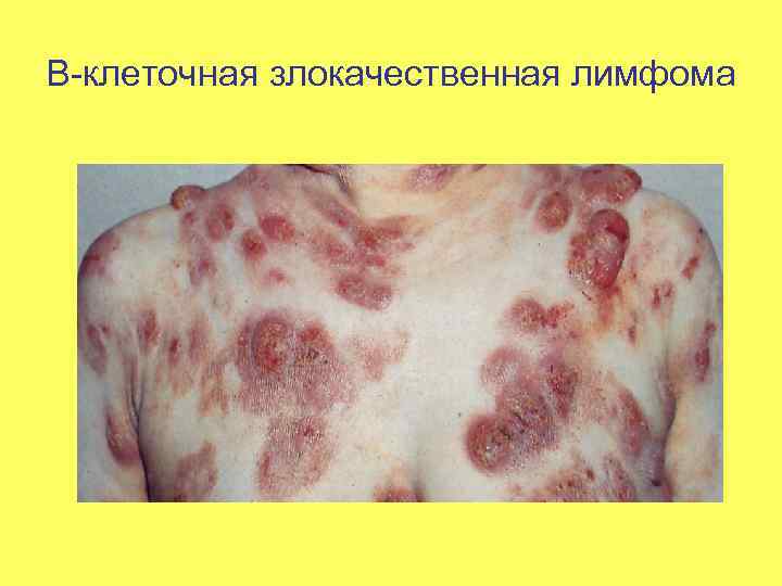 В-клеточная злокачественная лимфома 