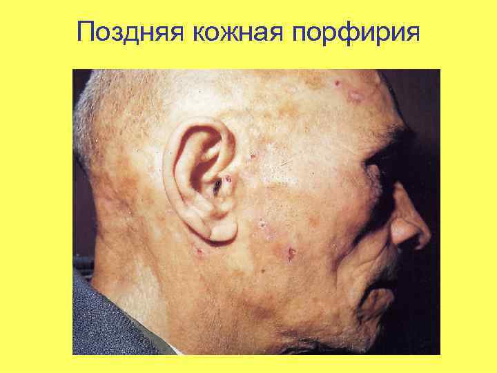 Поздняя кожная порфирия 