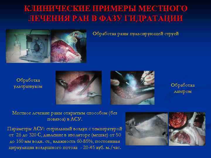 КЛИНИЧЕСКИЕ ПРИМЕРЫ МЕСТНОГО ЛЕЧЕНИЯ РАН В ФАЗУ ГИДРАТАЦИИ Обработка раны пульсирующей струей Обработка ультразвуком