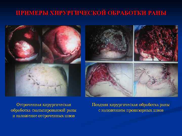 ПРИМЕРЫ ХИРУРГИЧЕСКОЙ ОБРАБОТКИ РАНЫ Отсроченная хирургическая обработка скальпированной раны и наложение отсроченных швов Поздняя