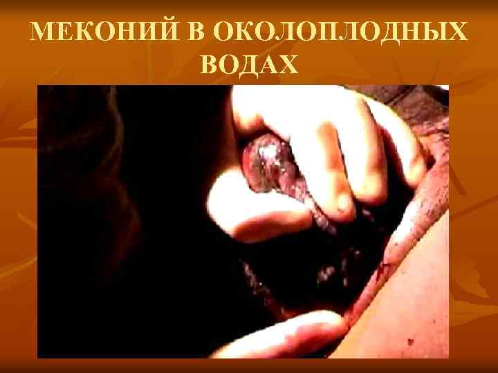 МЕКОНИЙ В ОКОЛОПЛОДНЫХ ВОДАХ 