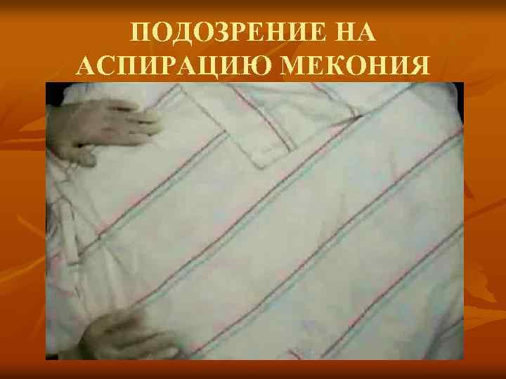 ПОДОЗРЕНИЕ НА АСПИРАЦИЮ МЕКОНИЯ 