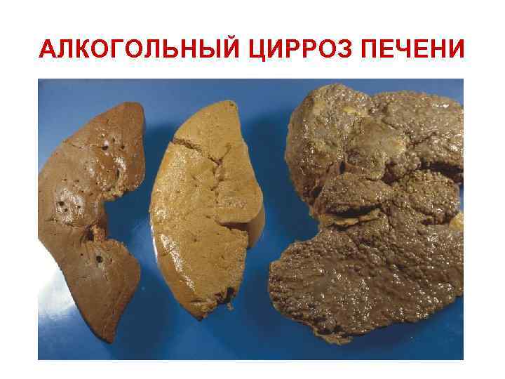 АЛКОГОЛЬНЫЙ ЦИРРОЗ ПЕЧЕНИ 