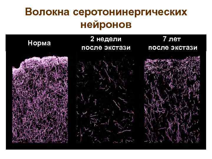 Волокна серотонинергических нейронов Норма 2 недели после экстази 7 лет после экстази 