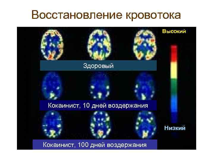Восстановление кровотока Высокий Здоровый Кокаинист, 10 дней воздержания Низкий Кокаинист, 100 дней воздержания 