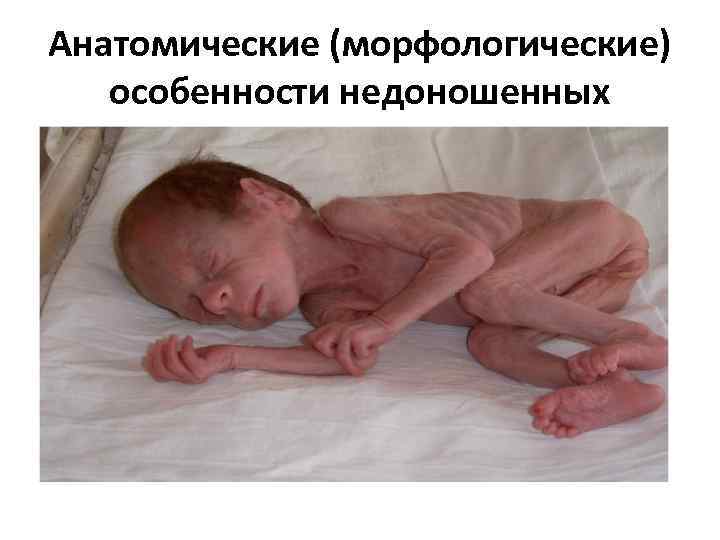 Анатомические (морфологические) особенности недоношенных 