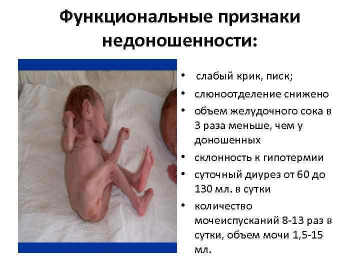 Функциональные признаки недоношенности: • слабый крик, писк; • слюноотделение снижено • объем желудочного сока