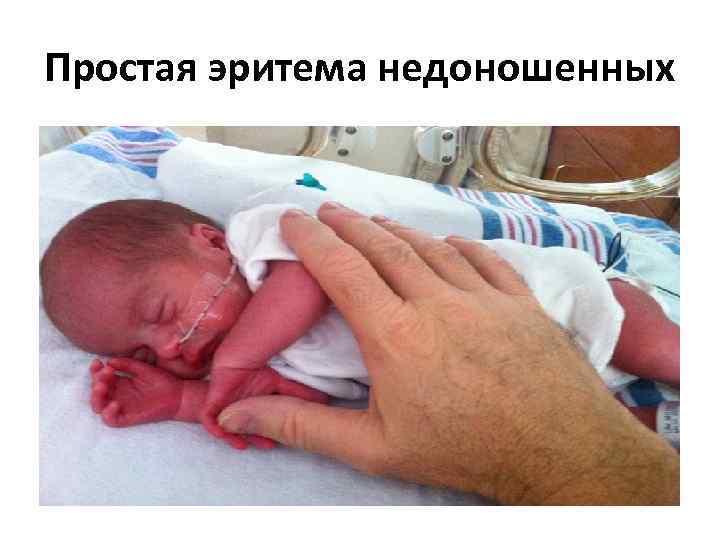 Простая эритема недоношенных 