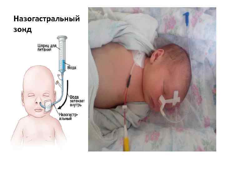 Назогастральный зонд 