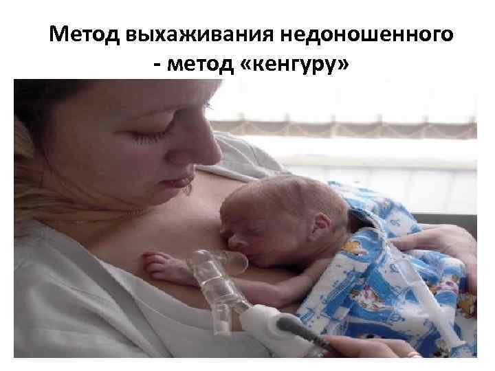 Метод выхаживания недоношенного - метод «кенгуру» 