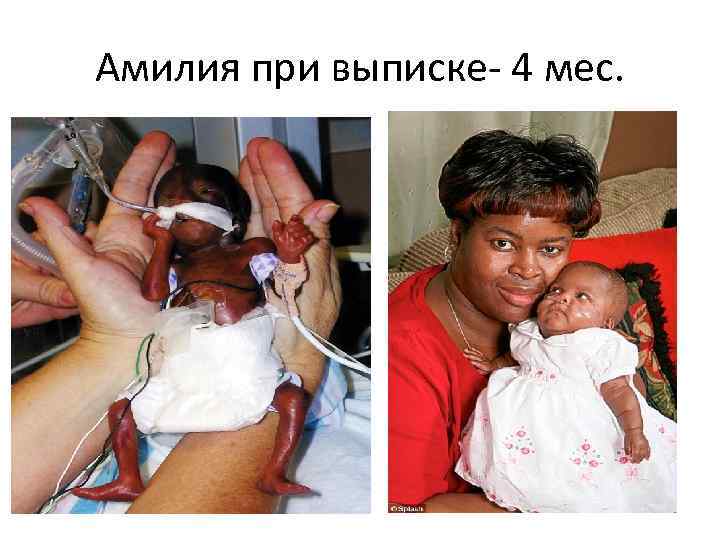 Амилия при выписке- 4 мес. 