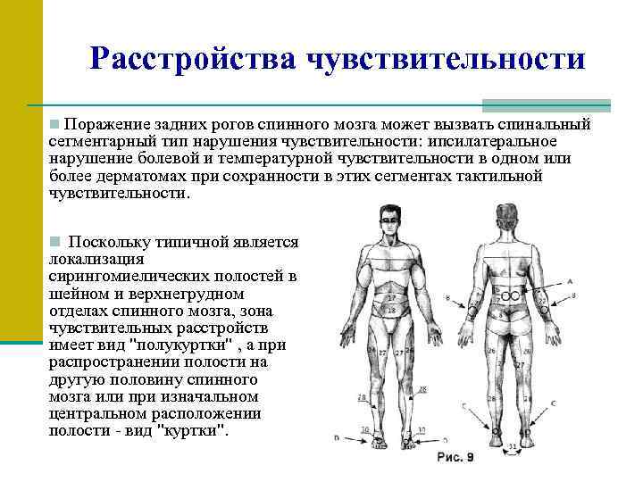 Расстройства чувствительности n Поражение задних рогов спинного мозга может вызвать спинальный сегментарный тип нарушения