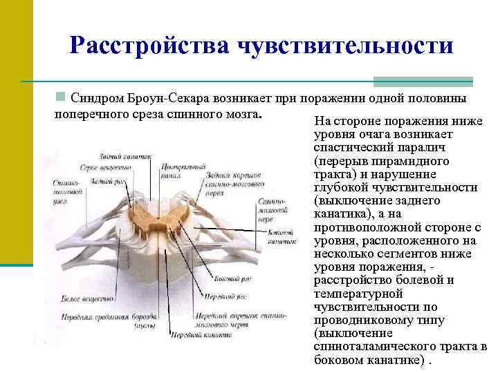 Расстройства чувствительности n Синдром Броун-Секара возникает при поражении одной половины поперечного среза спинного мозга.