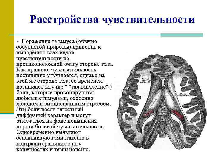 Расстройства чувствительности - Поражение таламуса (обычно сосудистой природы) приводит к выпадению всех видов чувствительности