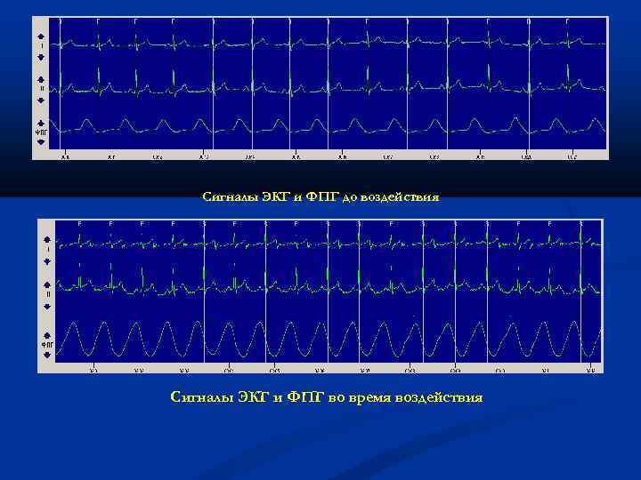 Сигналы ЭКГ и ФПГ до воздействия Сигналы ЭКГ и ФПГ во время воздействия 