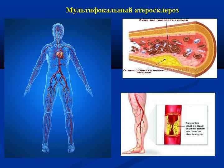 Мультифокальный атеросклероз 