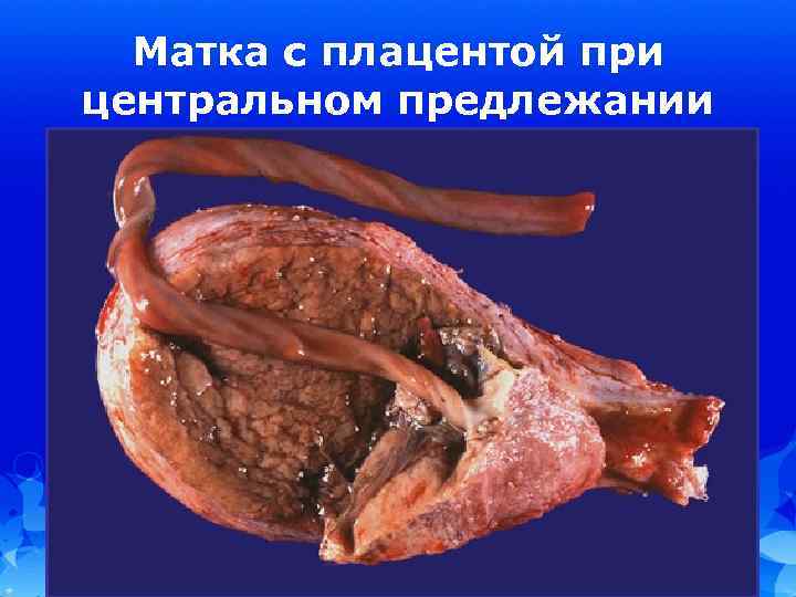 Матка с плацентой при центральном предлежании 